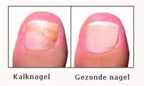 Kalknagel vs gezonde nagel